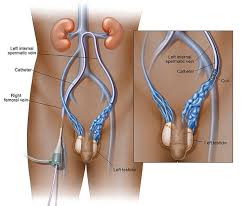 Effective Treatment for Varicocele: Understanding Embolisation